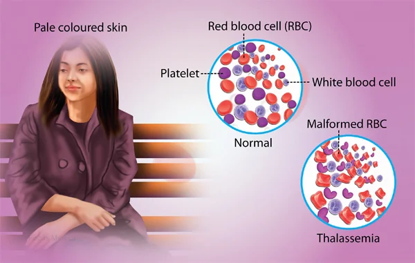 Thalassemia