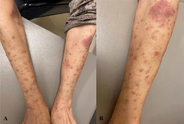 Leukemia