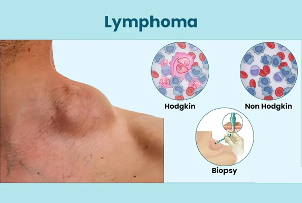 Lymphoma