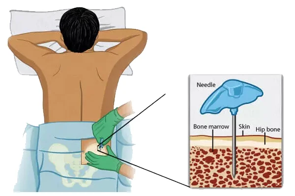 Bone Marrow Transplant